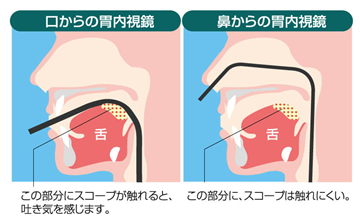 上部消化管内視鏡（胃カメラ）検査 | 医療法人 木村医院